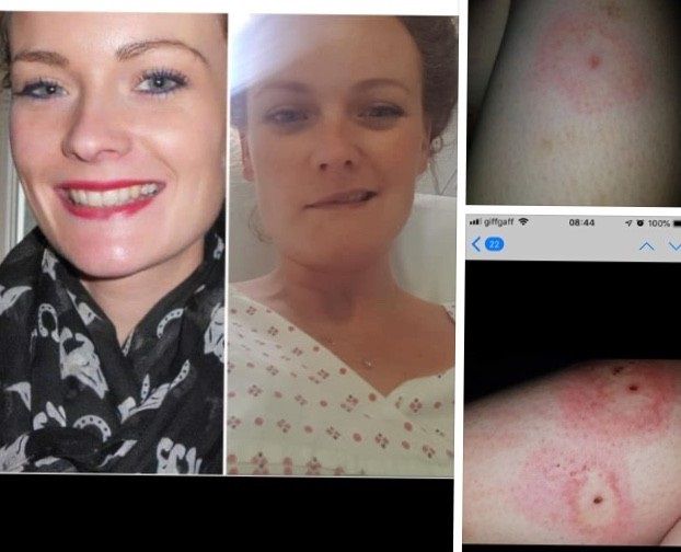 This is a friend of mine, Alyx.  She was bitten in summer 2019.